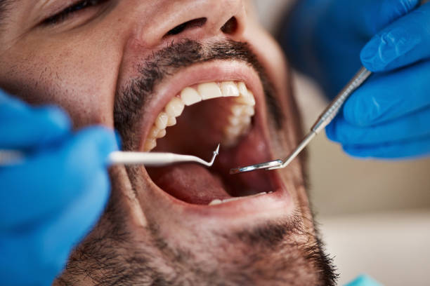 Best Emergency Dentist for Lost Fillings or Crowns in Gateway, AK